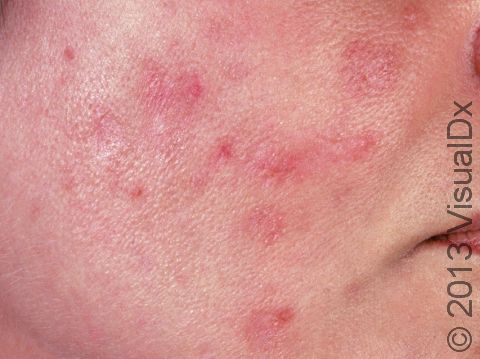 This image displays redness without active acne lesions from rubbing and picking at acne.