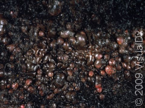 This image displays round, smooth bumps typical of acne keloidalis nuchae.