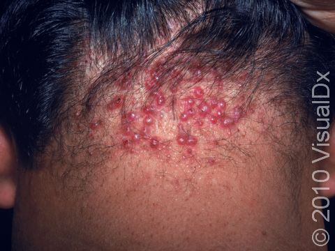 This image displays the back of the neck at the hairline that is affected by acne keloidalis nuchae.