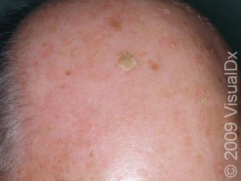 This image displays a bald scalp with areas of sun damage and actinic keratoses.