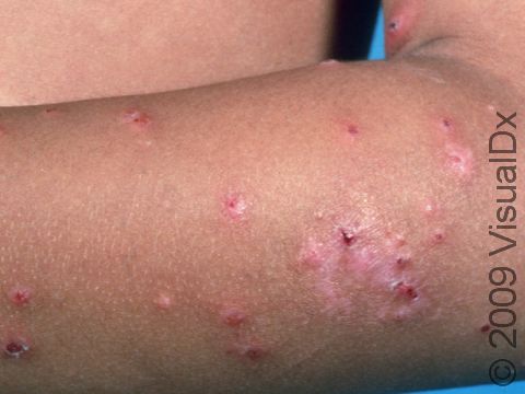 This image displays insect bites with bloody crusts due to severe itch and scratching.