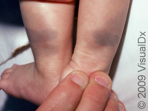 Blue-gray spots (Mongolian spots) typically occur on the buttocks and trunk; rarely, they can occur on the legs and arms.