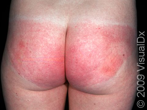 An allergy to a bathing suit frabic caused this rash.