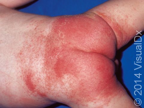 This image display bright red skin caused by persistent irritation.