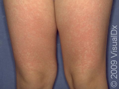 This image displays red, fluid-filled bumps typical of fifth disease.