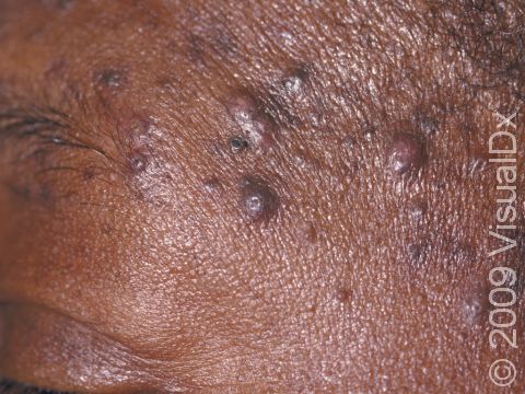 The lesions of folliculitis may be pus-filled, signifying an infection.