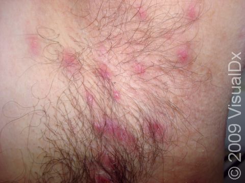 A teenage male with furunculosis (boils) displays CA-MRSA (community-associated methicillin-resistant Staphylococcal aureus), as confirmed by culture of the affected area.