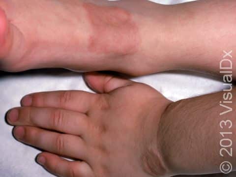 This image displays the tops of a hand and foot affected by granuloma annulare.