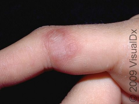 The herpes simplex virus infection on the finger is known as herpetic whitlow. Grouped, fluid-filled or pus-filled, blisters are typical and usually itch and/or are painful.