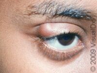 Stye (Hordeolum and Chalazion) – Child