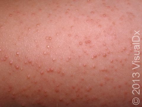 This image displays tiny, scaly elevations of the skin around the hair follicle typical of keratosis pilaris.
