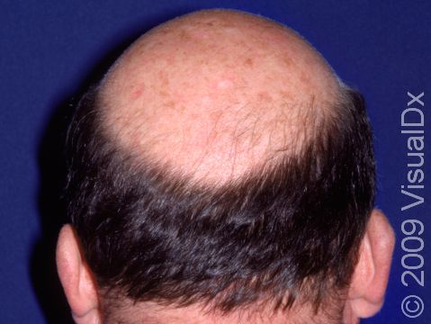 This image displays typical male pattern balding at the entire top of the scalp.