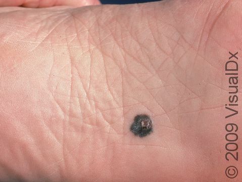 This melanoma started as a flat, irregular dark spot but has developed a raised, crusted area.