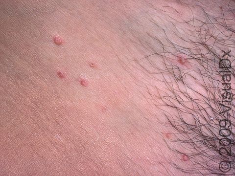 When seen in the genital region of an adult, molluscum transmission is usually due to intimate contact.