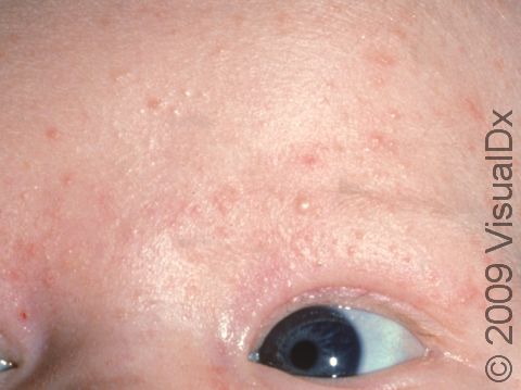 In neonatal acne, there can be redness as well as whiteheads.