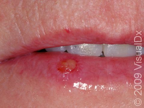 This image displays a mucosal blister caused by a herpes simplex infection.