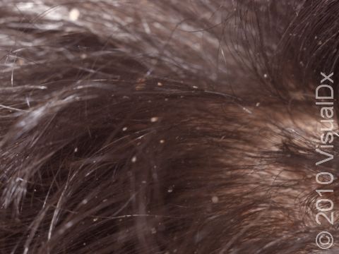 This image displays nits of lice on hair.