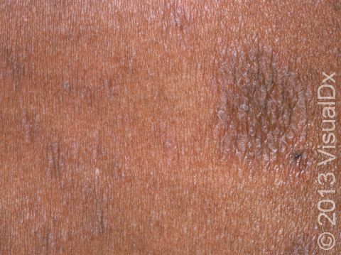 In people with darker skin, the small, scaly patches of pityriasis rosea may look more brown than pink.