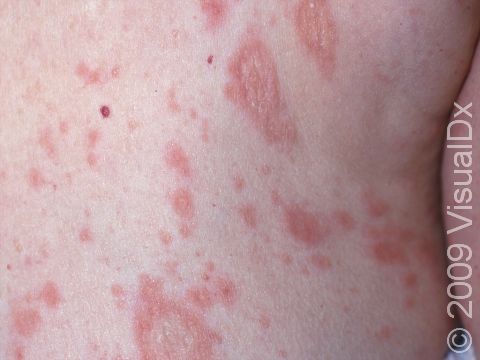 This image displays a rash with slight scaling that is typical of pityriasis rosea.