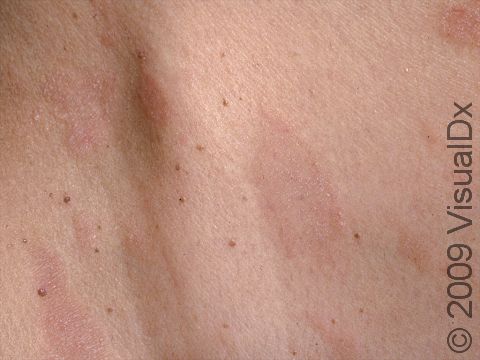 This image displays very fine, scaly, oval, slightly elevated lesions typical of pityriasis rosea.