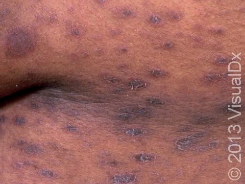 In people with darker skin, the rash of pityriasis rosea can appear as very dark, scaly, slightly elevated lesions.
