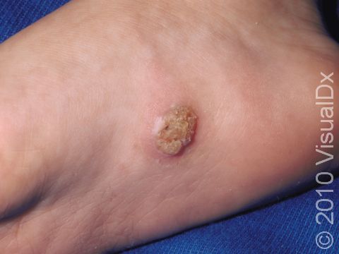 This image displays the thick scale associated with plantar warts (warts on the feet).