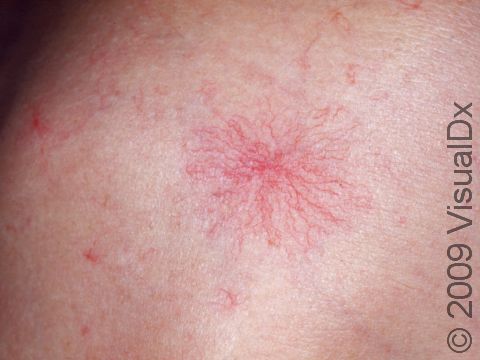 This image displays a central blood vessel with many 