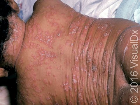 This image displays a widespread and severe case of viral exanthem.