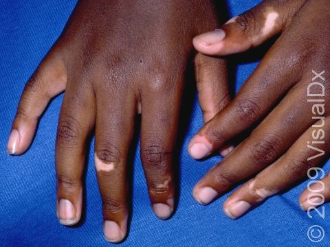 Vitiligo is an auto-immune condition that results in flat areas of pigment loss. Fingers are a common location.