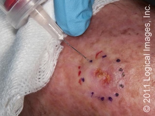 Mohs Surgey: What To Expect (Learning Series pt. II)