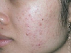 Treat Acne : Topical Retinoids