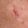 basal cell carcinoma