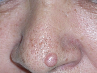 Reasons To Visit a Mohs Surgeon