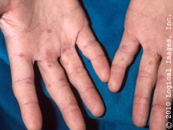 Managing Chilblains with an Active Outdoor Winter Lifestyle