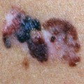 Melanoma