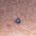 Melanoma