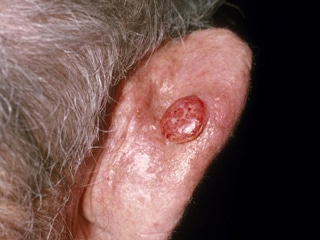 Squamous Cell Carcinoma