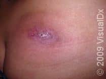 12 Days of Dermatology – Day Seven: MRSA