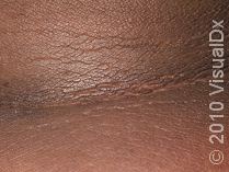 Acanthosis Nigricans
