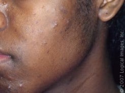 Acne in Skin of Color