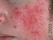 Natural Pimple Remedies: Do they work?