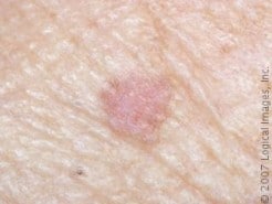 Prevent Skin Cancer with Topical Treatments