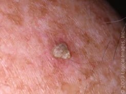 Levulan Kerastick Treatment