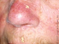 Skin Cancer Prevention Procedures