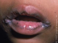 Stress May Cause Skin Rashes