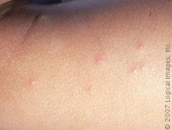 Mosquito Bite Relief