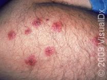 bedbug bites
