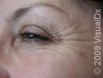 Day One: Botulinum Rejuvenation