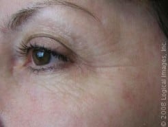 Q&A: Botox Alternatives?