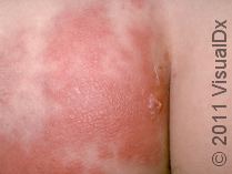 Cellulitis: What You Must Know about Warm, Red, and Swollen Skin